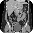 CT Abdomen Pelvis